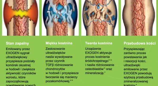 Ilustracja przedstawia etapy gojenia złamania kości piszczelowej, od stanu zapalnego po przebudowę kości, z uwzględnieniem powikłań po złamaniu kości piszczelowej.