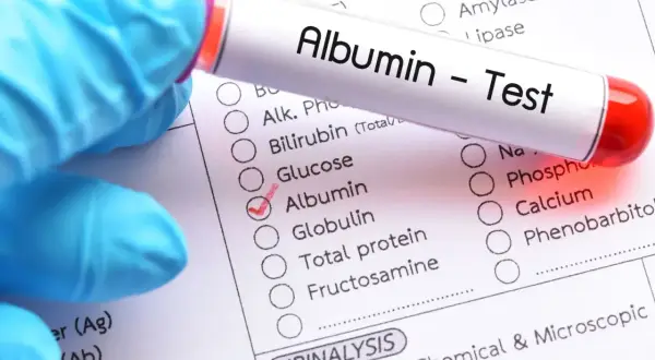 Rękawiczka medyczna trzyma probówkę z napisem "Albumin - Test". Na formularzu zaznaczono "Albumin", co sugeruje badanie poziomu albuminy.