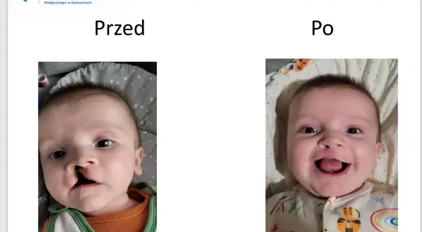 Uśmiechnięte dziecko z widoczną poprawą po operacji zajęczej wargi.