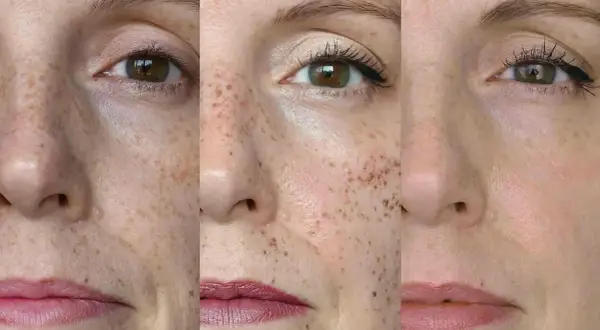 Trzy zbliżenia twarzy z piegami. Widać, jak można je subtelnie podkreślić, by nadać cerze naturalnego blasku i **cultivate** jej piękno.