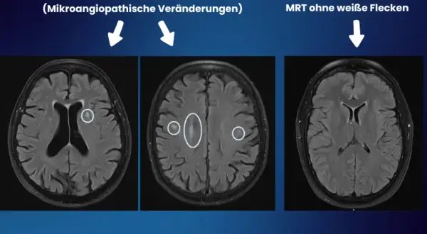 MRT-Aufnahmen zeigen weiße Flecken im Gehirn, die auf mikroangiopathische Veränderungen hindeuten. Diese können fazekas 2 symptome verursachen.