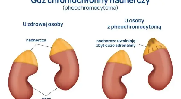 Guz chromochłonny objawy: jak rozpoznać niebezpieczne symptomy