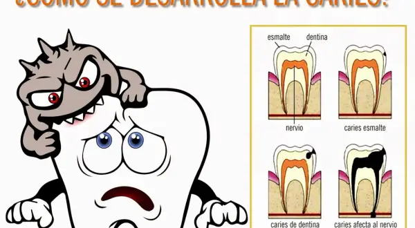 Monstruo atacando un diente triste. Diagramas de etapas de caries dental.