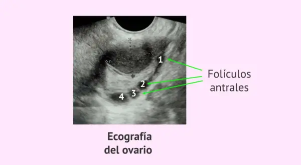 Ecografía ovárica que muestra varios folículos antrales, identificados con números del 1 al 4.