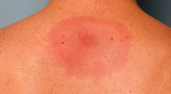 Consecuencias de una garrapata mal quitada en persona y cómo actuar