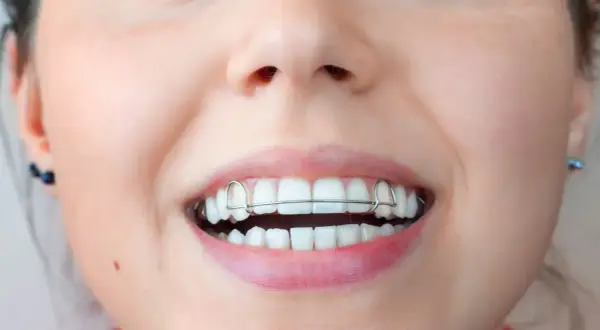 Uśmiechnięta twarz z aparatem retencyjnym. Metalowy retainer na zębach, który zapewnia idealny rezonans uśmiechu.