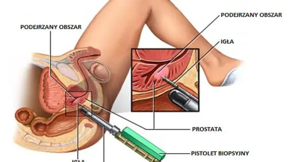 Badanie prostaty u urologa: Przebieg, przygotowanie i co musisz wiedzieć?