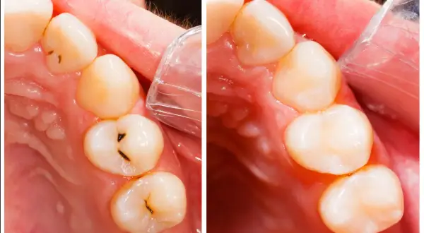 Dientes con caries antes y después del tratamiento. Se observa la mejora en la salud bucal tras la intervención.