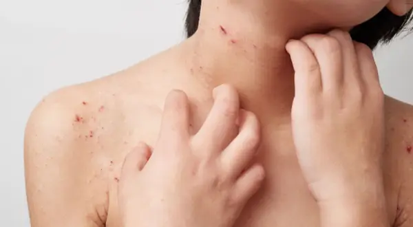 Haut mit roten Flecken und Kratzern, die auf starken Juckreiz hindeuten. Eine Hand kratzt sich am Hals und an der Schulter.