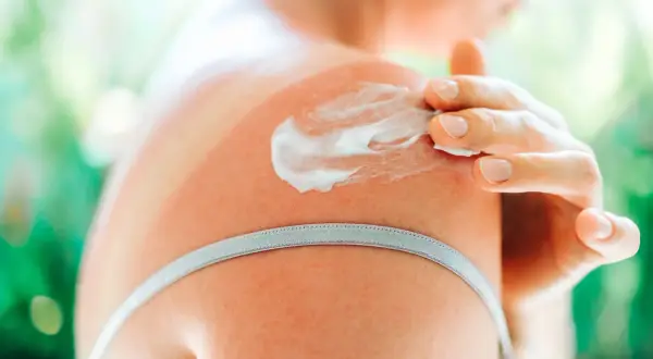Una mano applica crema doposole su una spalla arrossata dal sole. Utile per lenire e idratare la pelle dopo l'esposizione solare.