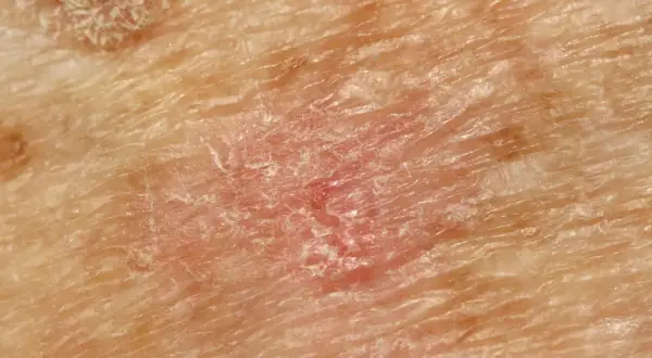 Nahaufnahme von Haut mit Rötung und Schuppung, typisch für aktinische Keratose.