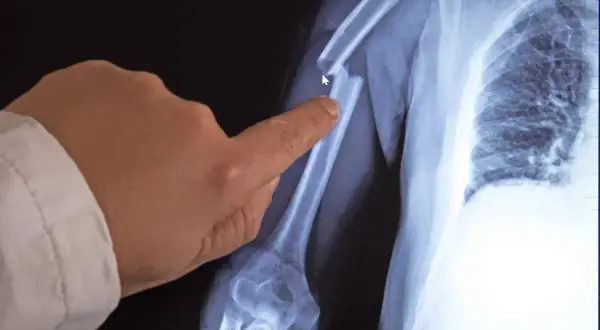 Röntgenbild eines gebrochenen Oberarms. Ein Finger zeigt auf die Bruchstelle. Möglicherweise ein Hinweis auf Knochenkrebs im Alter.