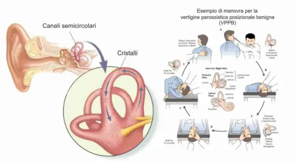 Illustrazione dell'orecchio interno e manovra per le vertigini parossistiche posizionali (VPPB), con i canali semicircolari e i cristalli.