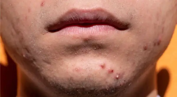 Nahaufnahme des Gesichts einer Person mit Akne im Kinnbereich. Entzündete Pickel und Mitesser sind sichtbar, was auf Akne mit 30 hindeutet.