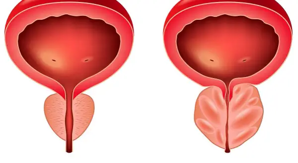 Porównanie pęcherza i prostaty: zdrowa prostata vs. przerost prostaty. Widoczny nacisk na gruczoł krokowy.