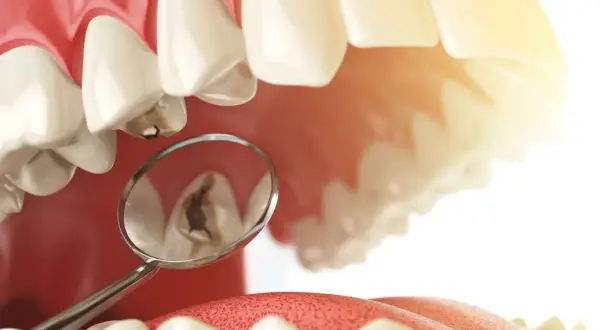 Zepsuty ząb widziany w lusterku dentystycznym. Dowiedz się, ile kosztuje plomba światłoutwardzalna, by przywrócić uśmiech.