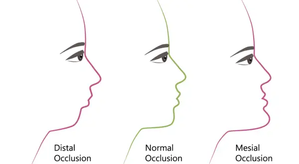 Metamorfoza twarzy po aparacie: Profil, usta, żuchwa co się zmieni?