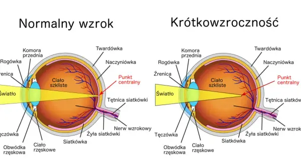 Porównanie budowy oka z normalnym wzrokiem i krótkowzrocznością. Ćwiczenia na poprawę wzroku mogą pomóc w zrozumieniu mechanizmów widzenia.