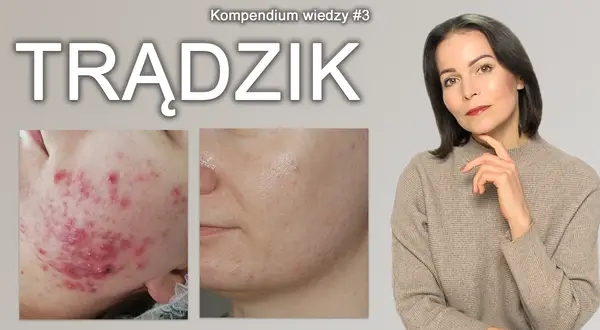 Pryszcze? Poznaj sekrety czystej cery i zapomnij o problemie!