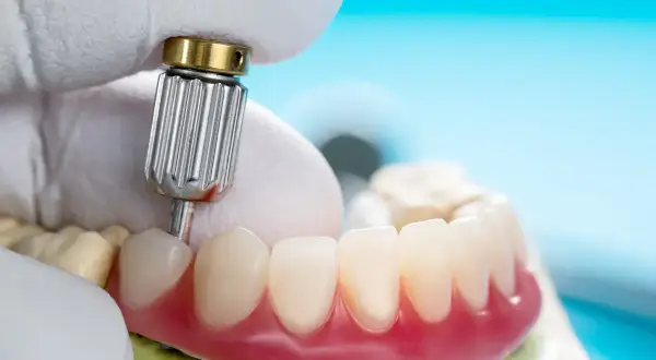 Dentyści pracują nad sztucznymi zębami na NFZ. Zbliżenie na protezę i narzędzie.