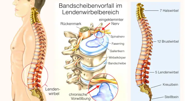 Illustration zeigt Bandscheibenvorfall im Lendenwirbelbereich, der Bandscheibenvorfall schmerzen im bein lindern kann. Eingeklemmter Nerv wird rot markiert.