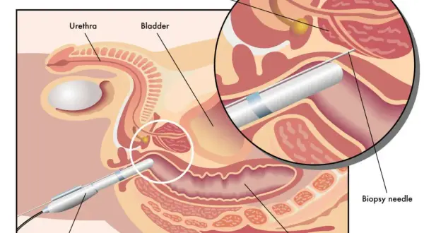 Illustration zeigt, was ist eine biopsie der Prostata. Eine Biopsienadel wird durch das Rektum eingeführt, um Gewebe zu entnehmen.