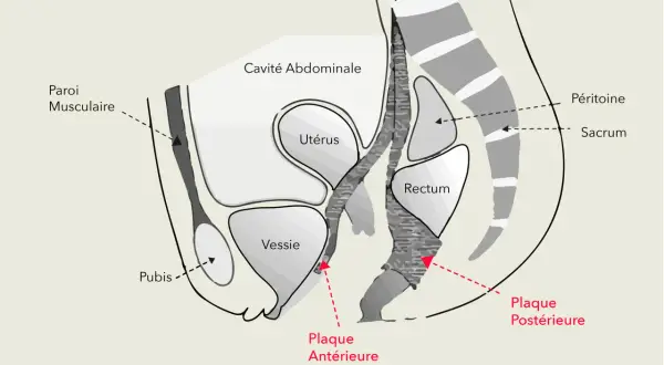 Coupe transversale du bassin féminin montrant la convalescence après promontofixation, avec utérus, vessie, rectum et plaques de fixation.
