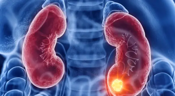 Darstellung von Nieren mit einem leuchtenden Tumor, der auf ein Nierenzellkarzinom hinweist, im Einklang mit der S3-Leitlinie.
