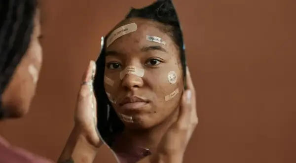 Riflesso di un volto con cerotti che recitano "acne is normal", "imperfect", "i'm not my skin", quando ti fanno sentire una nullità.