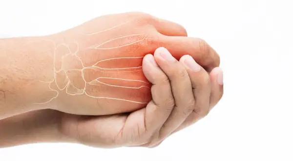 Schmerzende Hand mit Knochenstruktur und roter Entzündung. Ein Hoffnungsschimmer für eine Wunderwaffe gegen Arthrose Finger.