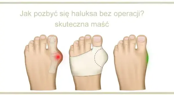 Apteczne sposoby na haluksy: Co naprawdę działa bez recepty?