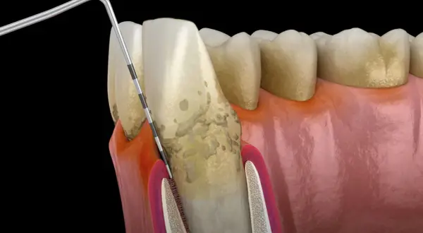 Narzędzie dentystyczne usuwa kamień nazębny z korony zęba i linii dziąseł.