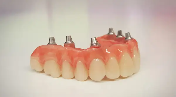 Proteza częściowa na NFZ z metalowymi elementami mocującymi, gotowa do implantacji.