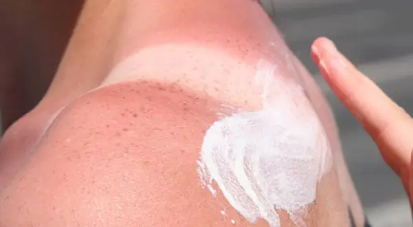 Schulter mit starkem Sonnenbrand, Rötungen und beginnenden Brandblasen. Eine Hand trägt Sonnencreme auf, um die Haut zu beruhigen.