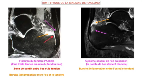 IRM montrant la maladie de Haglund : fissures du tendon d'Achille, conflit os-tendon et bursite.