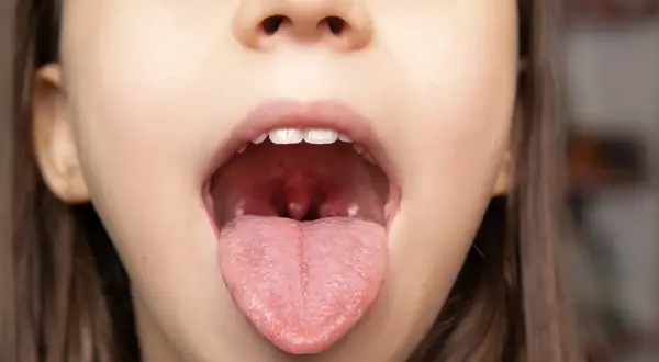 Zbliżenie na otwarte usta dziecka z widocznym językiem i migdałkami. W tle rozmyte wnętrze gardła, gdzie może być widoczny rak migdałka.