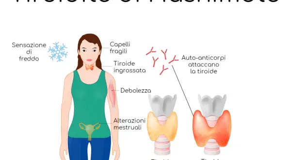 Illustrazione della tiroidite di Hashimoto: sintomi come freddo, capelli fragili, debolezza, alterazioni mestruali e auto-anticorpi che attaccano la tiroide, confrontando una tiroide normale con una infiammata.