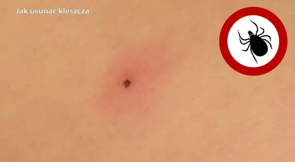 Jak bezpiecznie usunąć nimfę kleszcza? Szybki poradnik krok po kroku