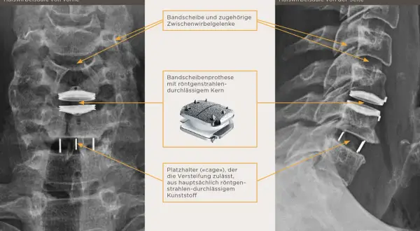 Röntgenbilder der Halswirbelsäule zeigen eine Bandscheibenprothese mit einem röntgendurchlässigen Kern und einem Platzhalter ("cage") für die hws versteifung.