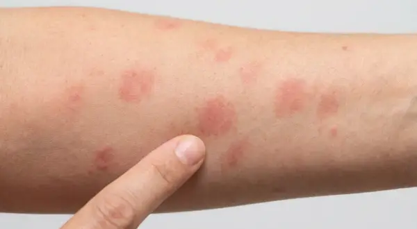 Ein Finger zeigt auf einen Arm mit mehreren kreisrunden roten Flecken auf der Haut. Mögliche Anzeichen für Hautkrebs oder andere Hautirritationen.
