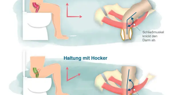 Hockstellung auf Toilette mit Hocker erleichtert den stuhlgang anregen, da der Darm gerade bleibt. Ohne Hocker wird der Darm abgeknickt.