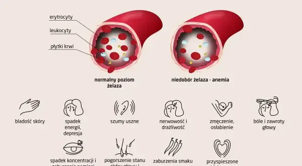 Ilustracja pokazuje naczynie krwionośne z normalnym poziomem żelaza i naczynie z niedoborem żelaza, co prowadzi do anemii. Objawy anemii to m.in. bladość skóry, spadek energii, bóle głowy.