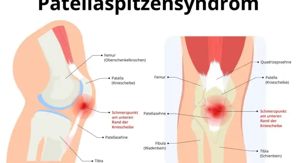 Illustration des Knies mit Hervorhebung des Schmerzpunktes an der Patellasehne, typisch für Patellaspitzensyndrom.