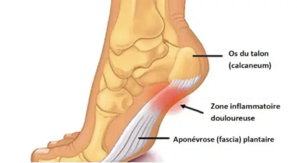 Anatomie du pied montrant l'aponévrose plantaire enflammée. Une bonne alimentation peut aider à gérer l'aponévrosite plantaire.