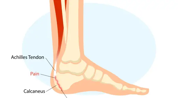 Schéma du pied montrant la maladie de Sever : douleur au talon (calcanéus) due à l'inflammation de la plaque de croissance, affectant le tendon d'Achille.