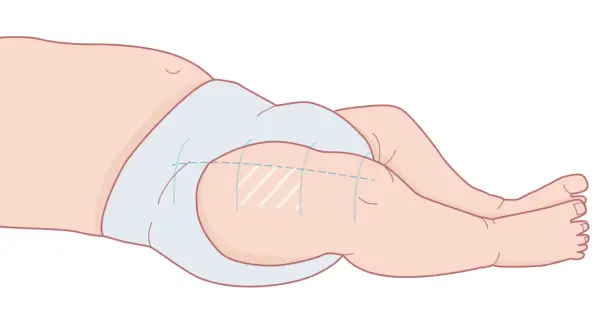 Illustration av ett barns lår med en ljusblå blöja. Markeringar på låret indikerar var 3 månaders vaccin ges.