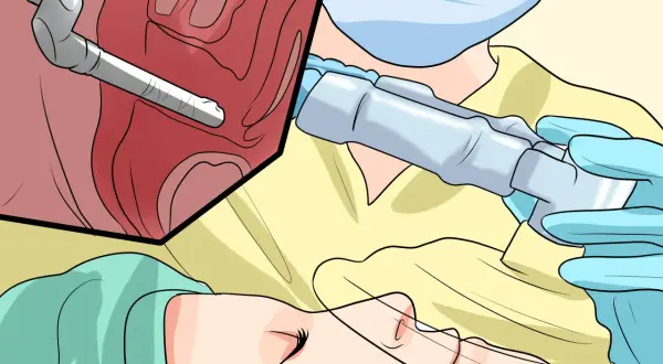 Chirurgie endoscopique pour une cystocèle grade 2. Un instrument médical est inséré dans une zone anatomique.