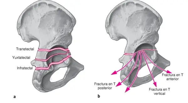 Ilustración de pelvis con fractura en rodete. A muestra tipos transtectal, yuxtatectal e infratectal. B muestra fractura en T anterior, posterior y vertical.