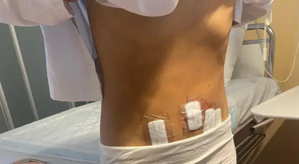 Efter operation för cysta i magen, syns plåster på ryggen.