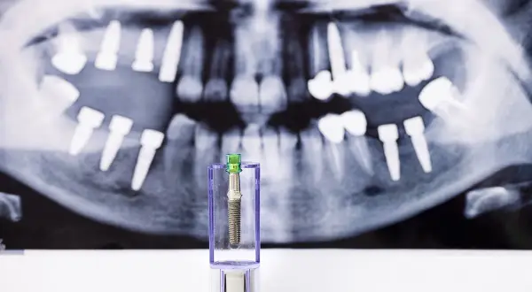 Implant dentystyczny w opakowaniu na tle zdjęcia rentgenowskiego szczęki z implantami. Obraz symbolizuje ryzyko odrzucenia przeszczepu kości pod implant.